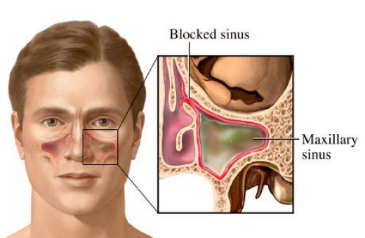 Are Sinus Infections Contagious Family Health Desk   Are Sinus Infections Contagious 